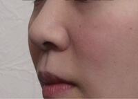 低鼻・丸鼻・上向き鼻を整える手術