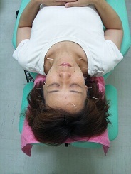 美容鍼灸体験しました！ 2012/06/07 14:22:23