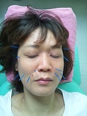 ほうれい線にも美容鍼です。 2012/06/19 13:32:35