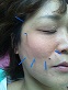 ほうれい線にも美容鍼です。