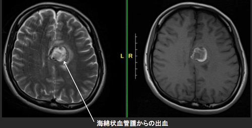 めまいの治療