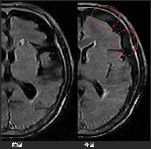 架橋静脈損傷