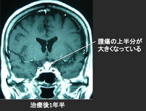 腎癌の全身転移