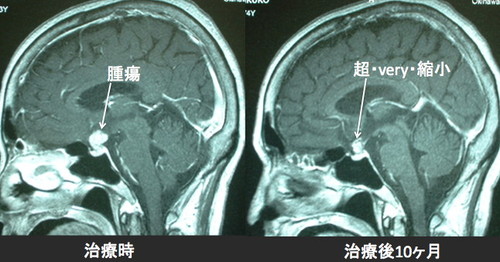 腎癌の全身転移