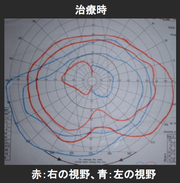 腎癌の全身転移