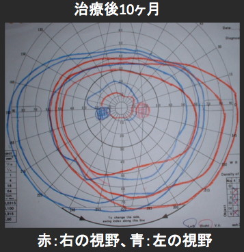 腎癌の全身転移