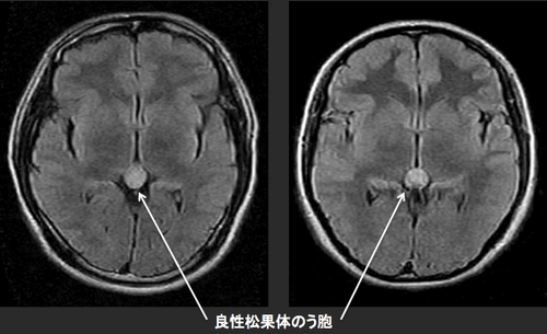 良性松果体のう胞 Dr さむらのハイパー気まぐれ日記