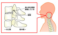 首が回らない。変形性頸椎症のお客さん 2012/11/05 09:13:56